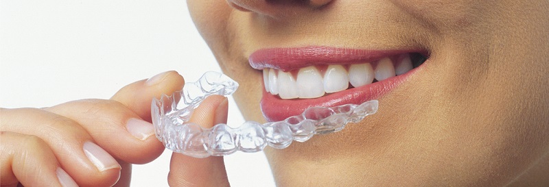 invisalign